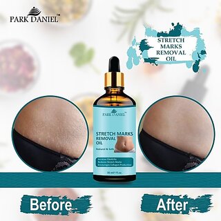 PARK DANIEL Premium Stretch Marks Removal Oil & Even Out Skin Tone Pack of 1 30 ML (30 ml) view 2