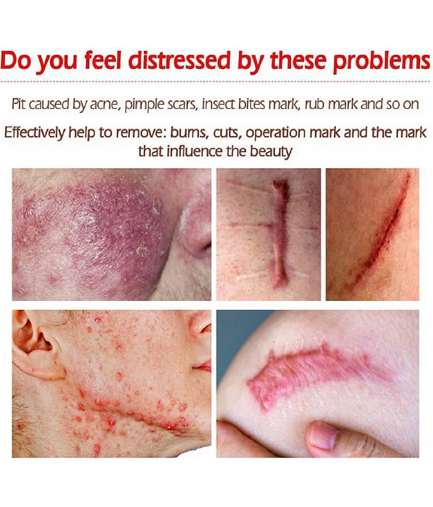 KURAIY Acne Face Cream Herbal Pimple Scar Removal Shrink Pore Oil Control Facial Cream view 2