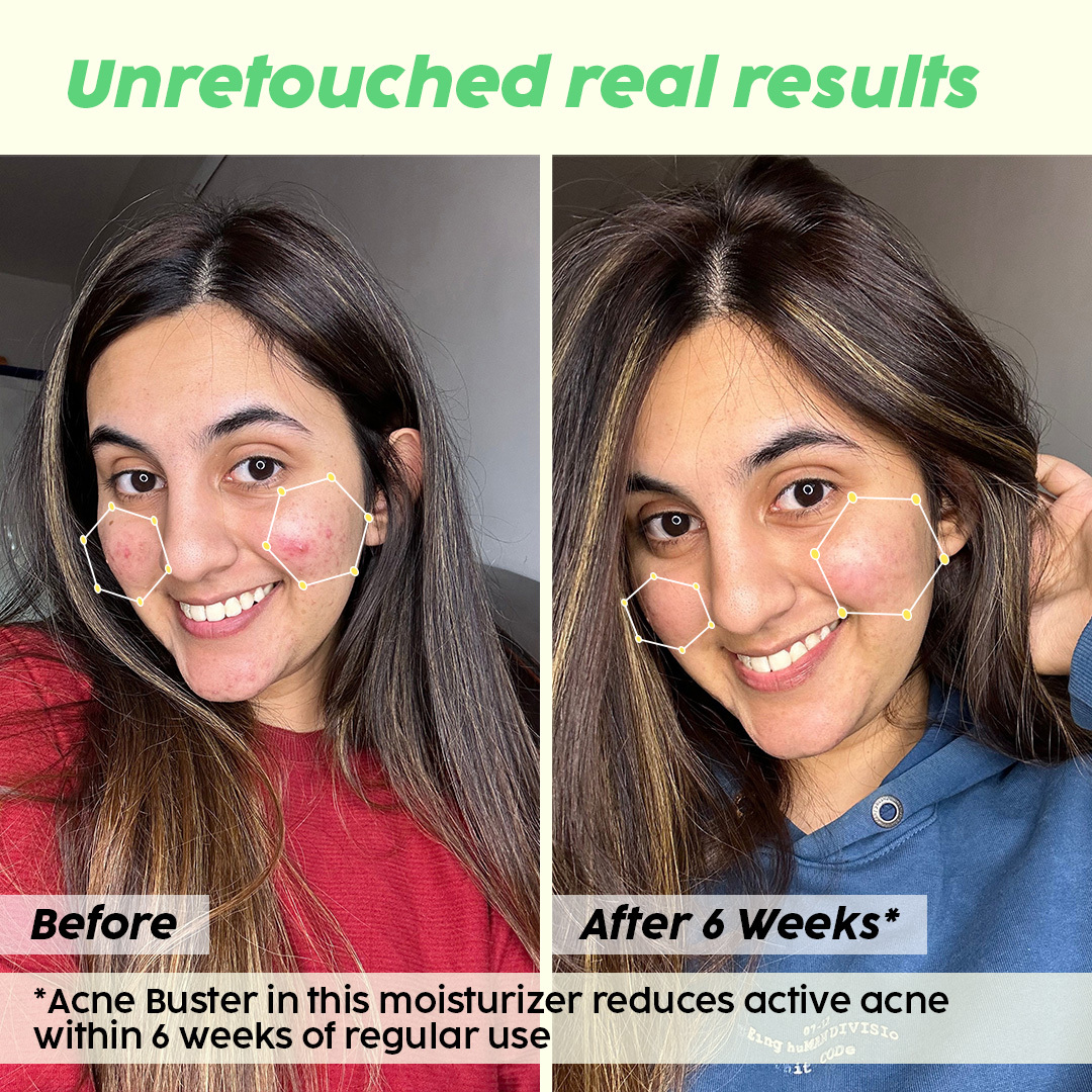 Jamun Niacinamide Moisturizer For Active Acne & Pimples __Starter Pack__ view 2