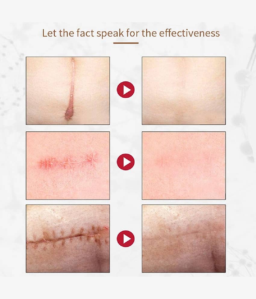 KURAIY Acne Face Cream Herbal Pimple Scar Removal Shrink Pore Oil Control Facial Cream view 2