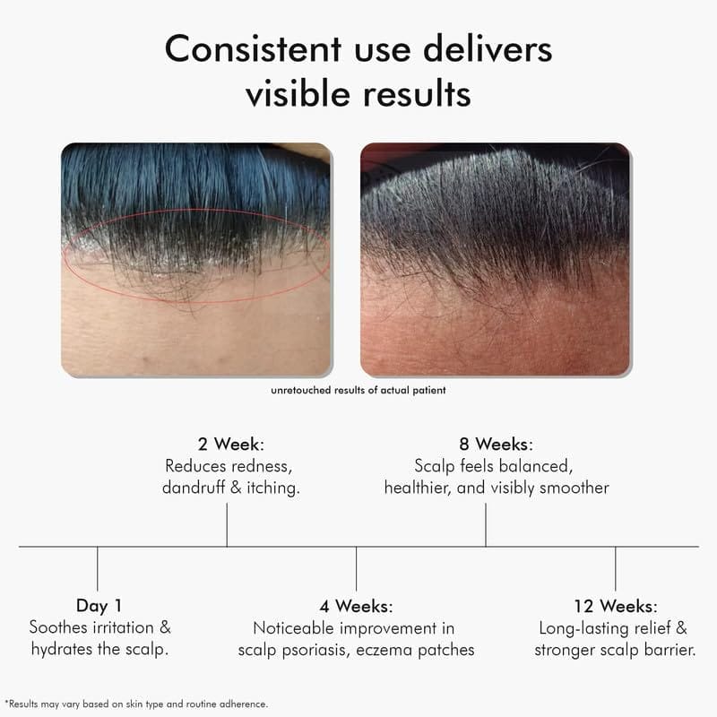 VedicDerm Charcoal Shampoo for Psoriasis, Dandruff, Sensitive Scalp view 2