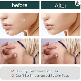 36 Pieces, Acne and Skin Tag Removal Patches, Absorbing Cover, Invisible, Blemish Spot, Hydrocolloid, Skin Treat view 2