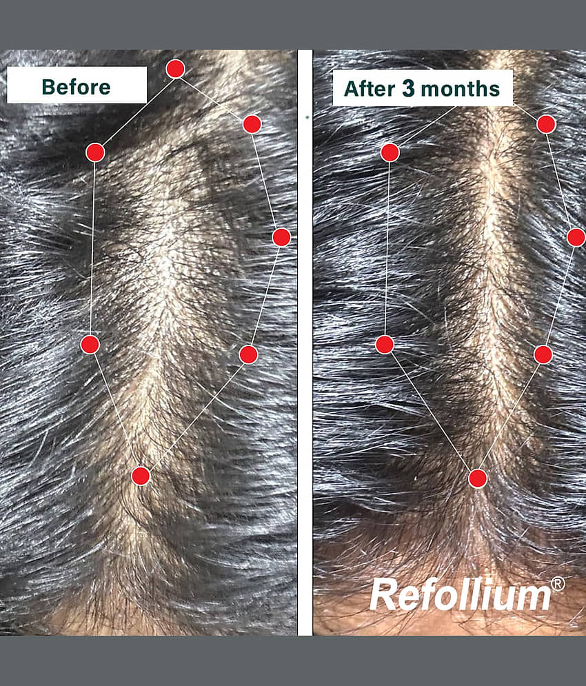 Refollium Anti Hair Fall Shampoo 150 ( Pack of 2 ) view 2
