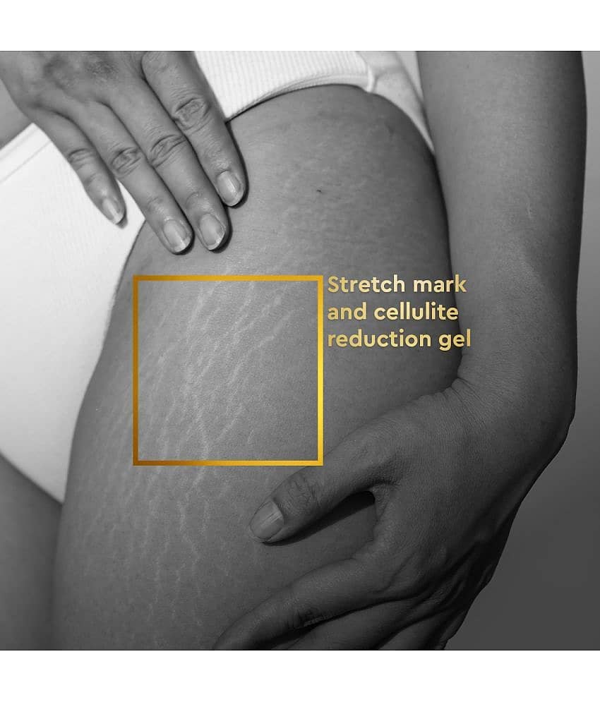 VLCC Clinic Anti Stretch Marks Reducing Cream - 100 ml - Firms And Tightens Skin view 2