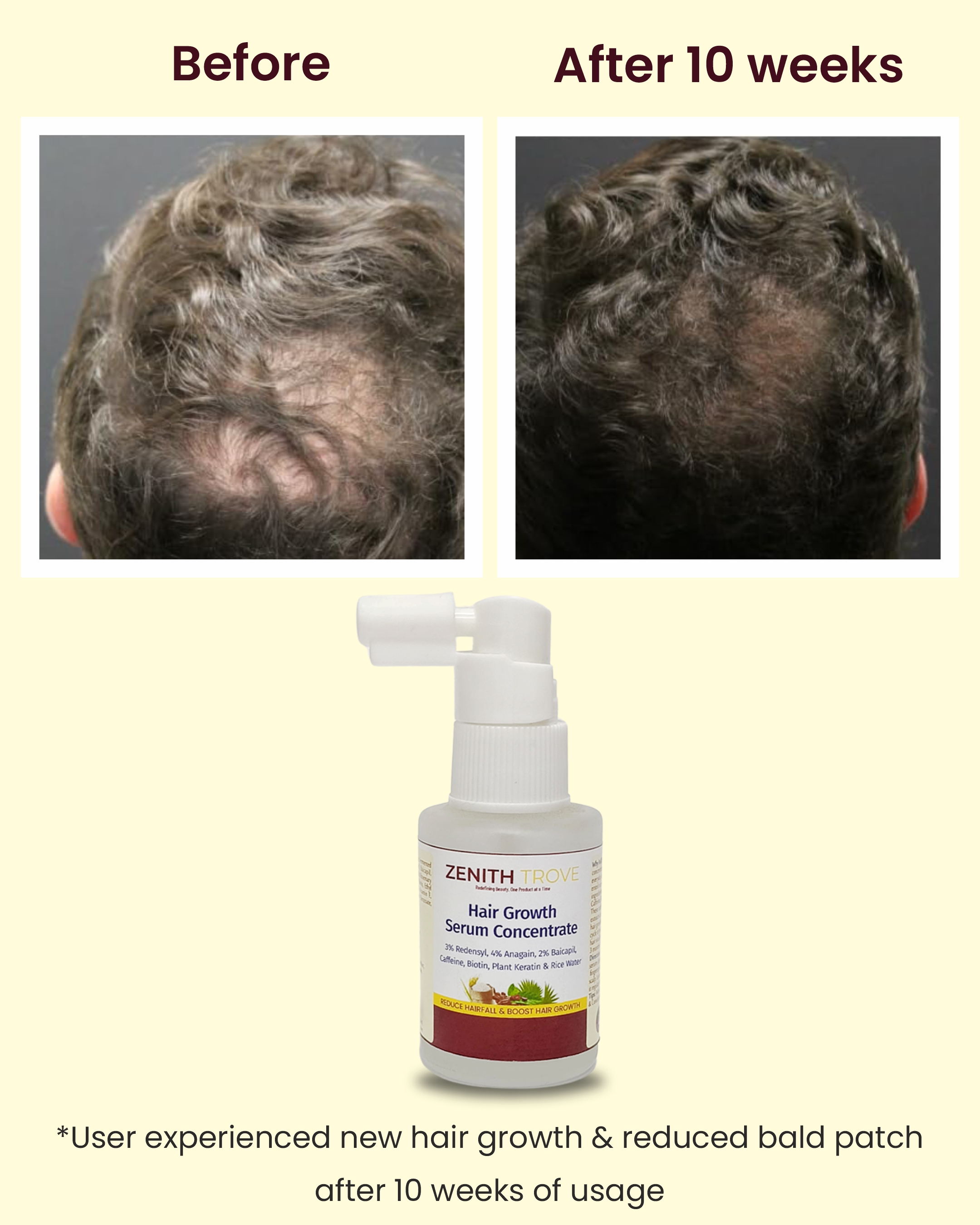 Zenith Trove Advanced Hair Growth Serum – 3% Redensyl, 4% Anagain, 2% Baicapil with Caffeine, Biotin & Rice Water | Hair Fall Control & Regrowth Booster | 30ml