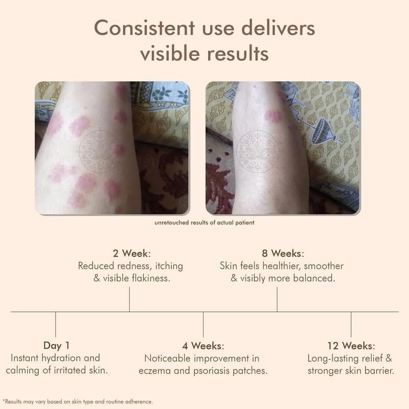 VEDICDERM Psoriasis Skin Care Oil Natural, Steroid-Free Formula for Dry, Itchy, and Flaky Skin Helps Soothe Irritation, Redness, & Promote Hydration, Suitable for Daily Use view 2