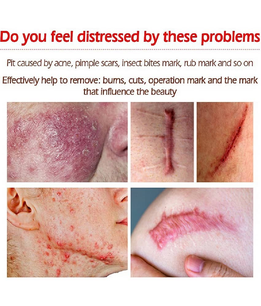 KURAIY Scar Removal Cream Gel Remove Acne Spots Treatment Pack of 3 view 2