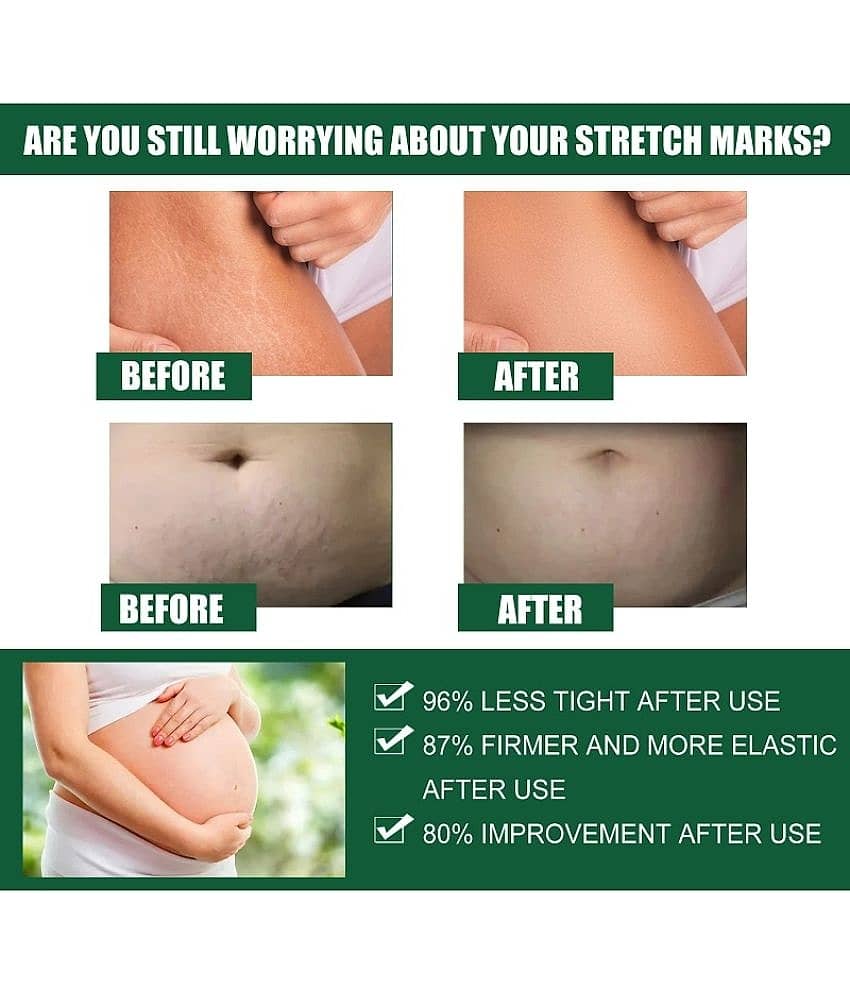 KURAIY Remove Pregnancy Mark Body Cream Treatment Scars Acne Stretch Marks Cream view 2
