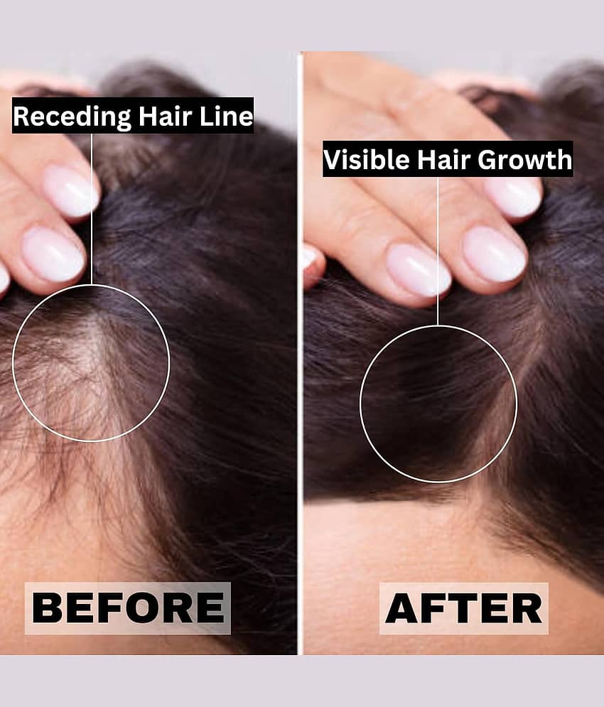 Refollium® Derma Roller 1.00 mm with box | With 540 Titanium Alloy Needles | Promotes Beard & Hair Growth & Reduces Acne Scars | Safe & Effective to Use view 2
